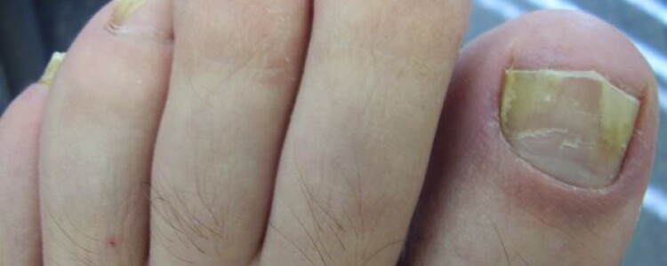 Борьба с колоректальным раком в Латинской Америке