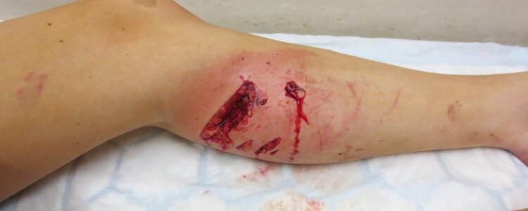 После окончания карьеры в НФЛ у чернокожих игроков больше проблем со здоровьем, чем у белых