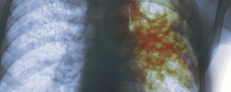 Пробные испытания новой техники управления перепадами настроения при биполярном расстройстве