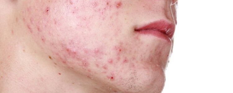 FDA одобрило комбинацию из 4 препаратов для лечения метастатического рака поджелудочной железы первой линии