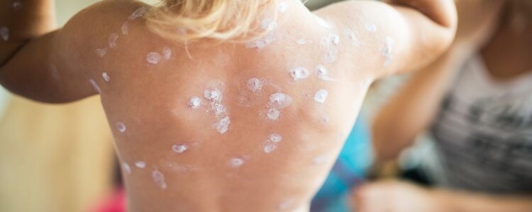 Пиелонефрит что это