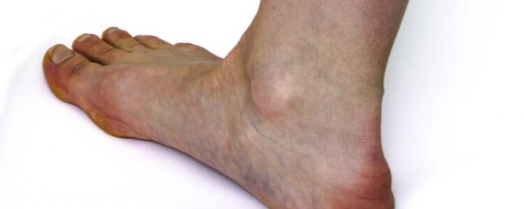 Существующие заболевания суставов