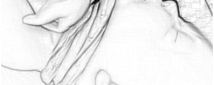 Острый пиелонефрит