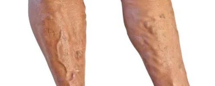 Почему немеют пальцы ног