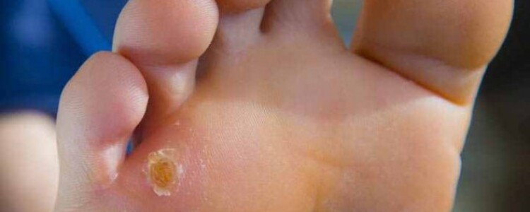 Клейкая нежность — безглютеновая диета