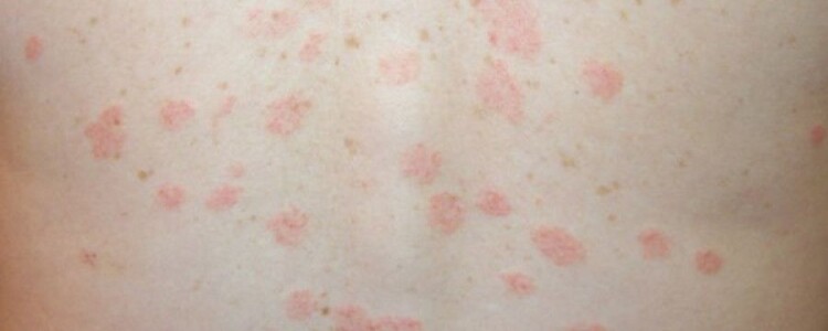 Обнаружены сбои в производстве белка при болезни Хантингтона