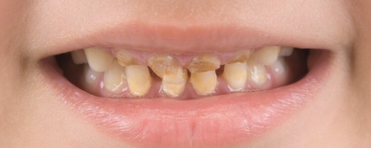 Сахарный диабет — витаминотерапия