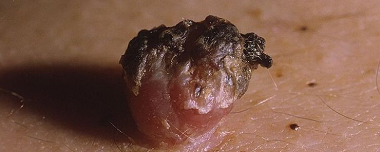 Исследования позволяют лучше понять биологию глазных осложнений, вызванных диабетом