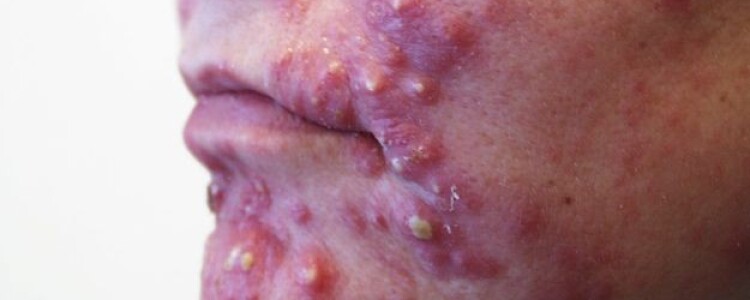 Пиелонефрит — лечение антибиотиками